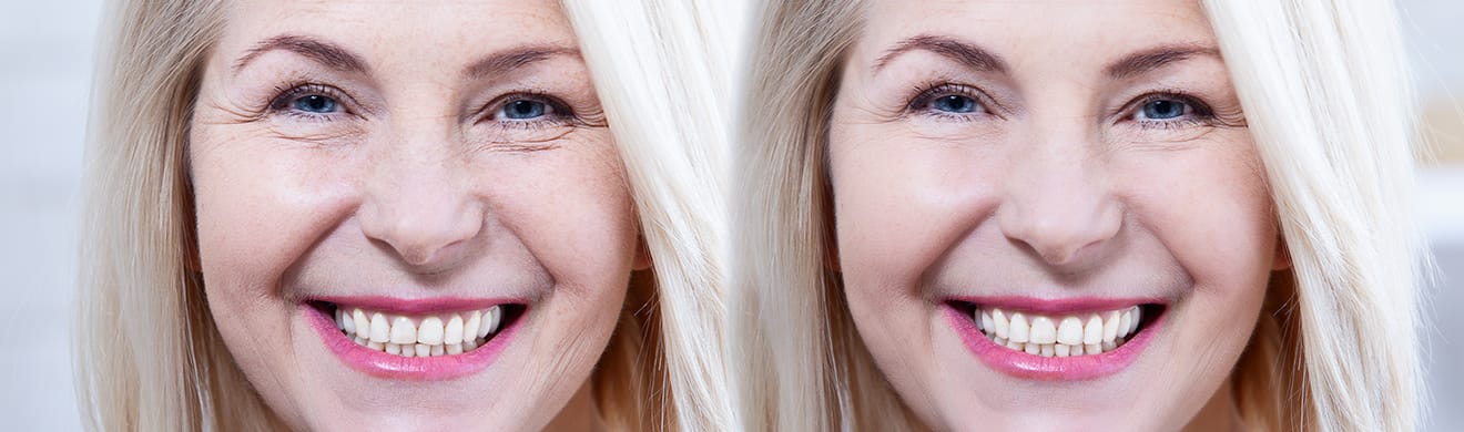 Vorher und nachher Ergebnis einer Anti Aging-Behandlung in Kiel, sichtbar verjüngte glattete Haut.